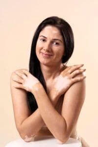 vitiligo Florianópolis Rafaela Salvato dermatologista